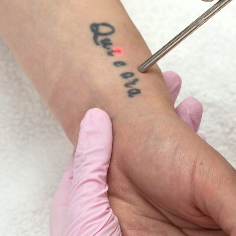 A specialist uses a precision laser tool to remove a black ink tattoo from a patient's wrist.