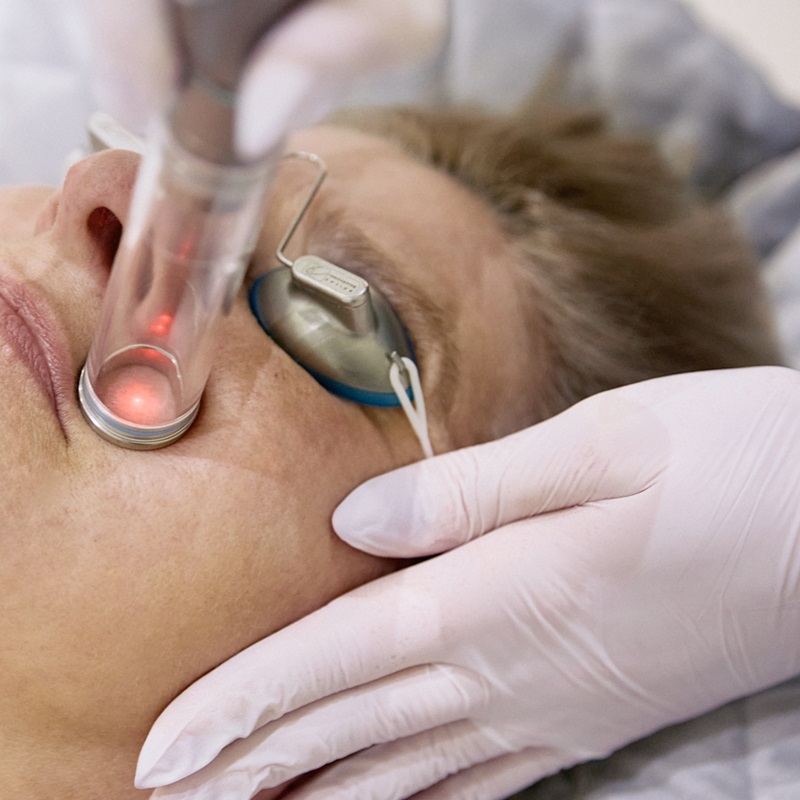 A close-up of a patient receiving a precise laser skin treatment while wearing protective eye shields.