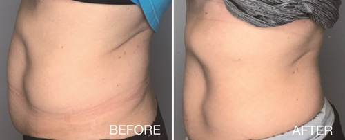 Before and after images showcasing aesthetic laser skin improvements