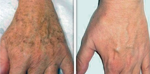 Laser treatment for age spots by Dr. Kozarev for even skin tone