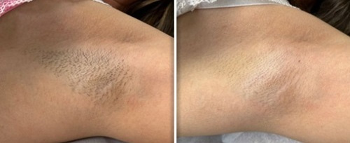 AvalancheLase hair removal treatment with powerful cooling system