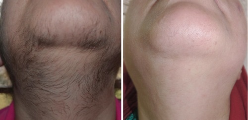 Neck skin tightening with advanced laser technology for firmer results