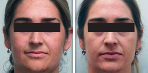 Twin toning laser facial results by Dr. Goodall for radiant skin
