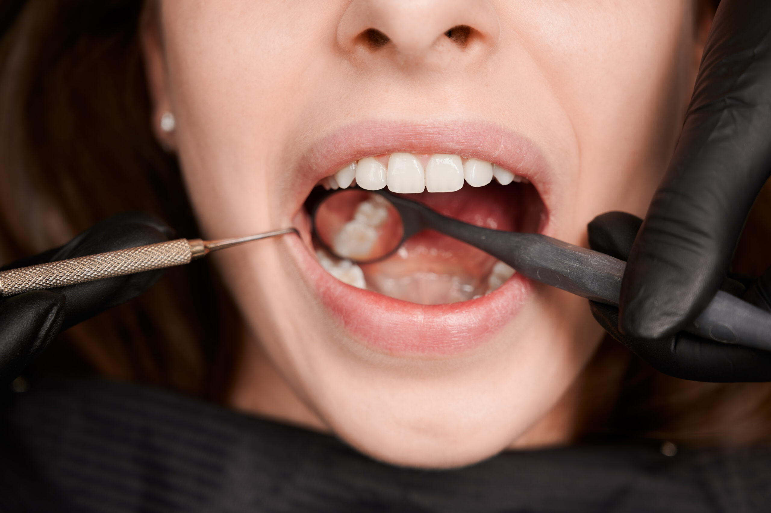 Dentist examining patient teeth with dental mirror and scaler during professional oral checkup in clinic setting