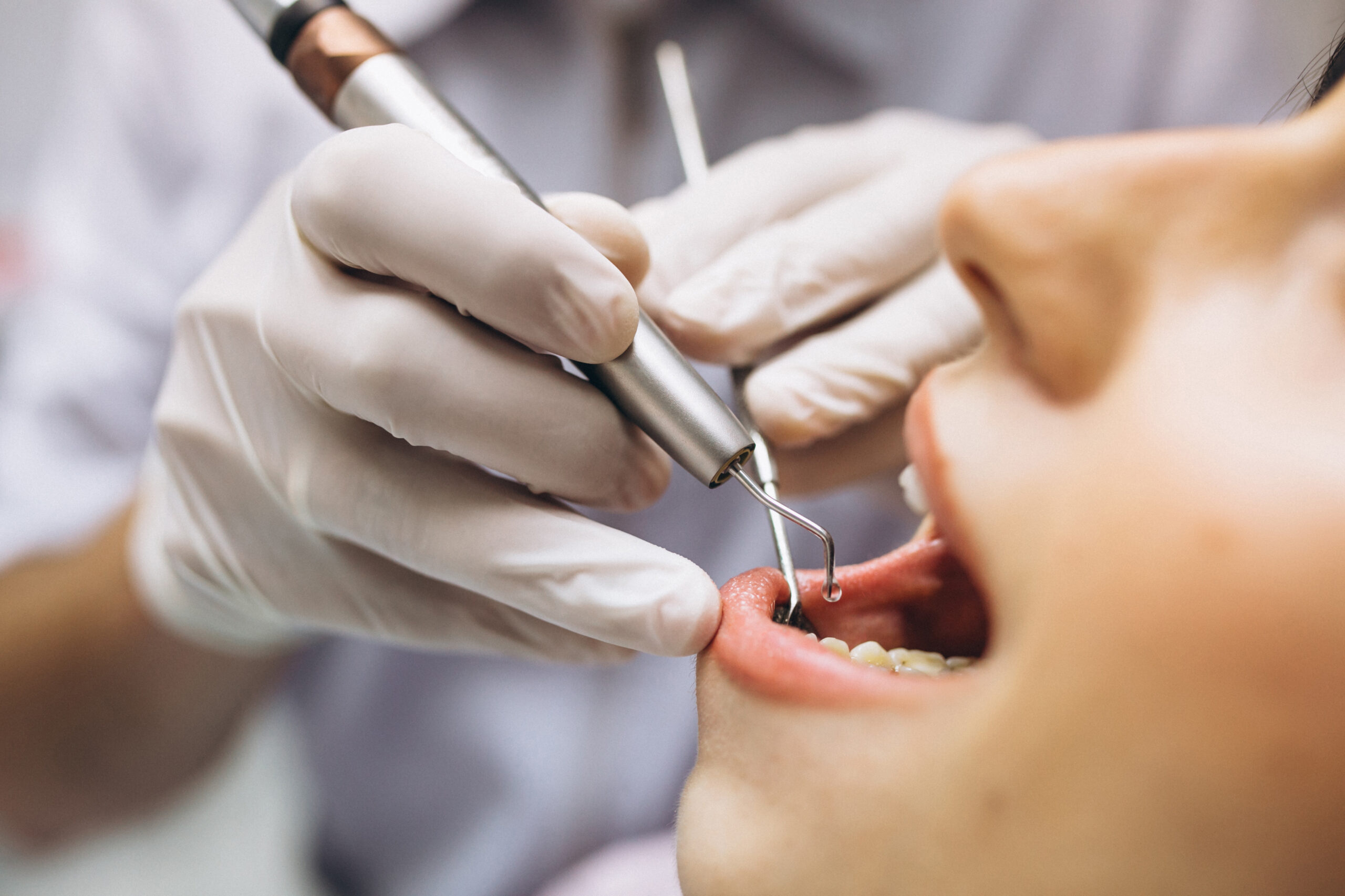 Close-up of dentist performing dental cleaning procedure using scaler tool on patient teeth in modern clinic setting