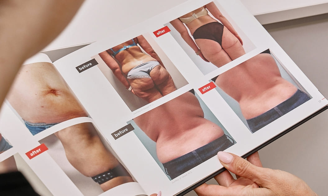 The Advantages of Our Medical Equipment A person reviews a catalog displaying "before" and "after" body contouring results from aesthetic treatments.
